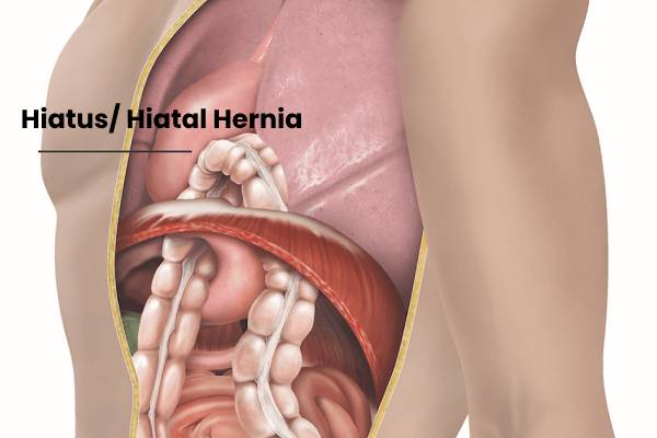 Hiatal Hernia Treatment in Chennai