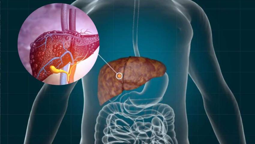 All you need to Know about Fatty Liver