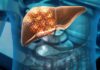 Liver Metastasis Treatment in Chennai