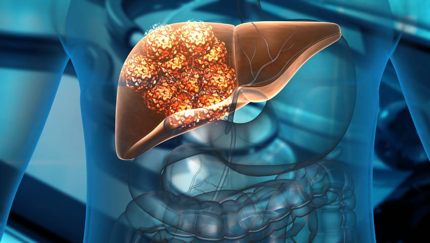 Liver Metastasis Treatment in Chennai