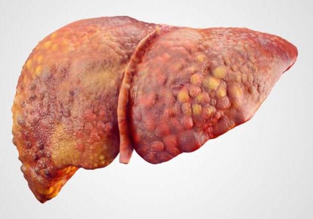 Liver Cirrhosis Treatment in Chennai - Dr. Srivatsan Gurumurthy