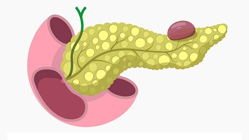 All you know about the Pancreatic Pseudocysts - Dr. Srivatsan Gurumurthy