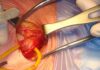 Hernia Recurrence with Advanced Surgical Care.