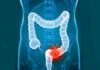 Importance of Early Detection in Colorectal Cancer